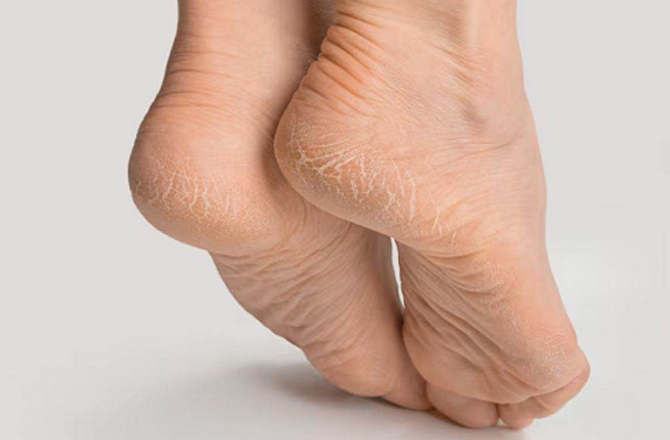 <div><strong>پھٹی ایڑیاں</strong></div>
<div>ایک بڑے برتن میں گرم پانی ڈال دیں اور اس میں تھوڑا سا نمک شامل کر دیں۔ اب اس گرم پانی میں اپنے پیروں کو بھگو دیں۔ پندرہ سے بیس منٹ بعد پیروں کو تولیہ سے اچھی طرح خشک کریں اور پیٹرولیم جیلی لگائیں اور کاٹن کی جرابیں پہن لیں۔ پھٹی ایڑیوں سے نجات پانے کا آسان طریقہ ہے۔</div>
<p>&nbsp;</p>