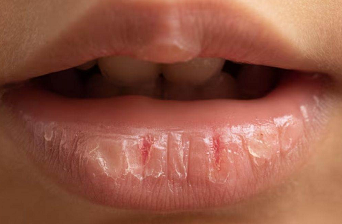 <div><strong>پھٹے ہوئے ہونٹ</strong></div>
<div>پھٹے ہوئے ہونٹوں پر پیٹرولیم اسی طرح لگائیں جیسے آپ کسی چپسٹک یا لپ اسٹک کو لگاتے ہیں۔ خشک جلد والی خواتین کو سردیوں میں تکلیف کا سامنا کرنا پڑتا ہے۔ کاسمیٹک کے طور پر پیٹرولیم جیلی کا استعمال ایسی جلد کو نمی بخشتا اور علاج کرتا ہے۔</div>
<p>&nbsp;</p>