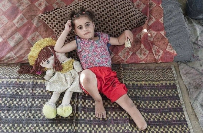 غزہ:۴؍ سالہ بچی کٹے پاؤں کا درد سہتے ہوئے دوبارہ کھیلنے، دوڑنے کے خواب دیکھتی ہے