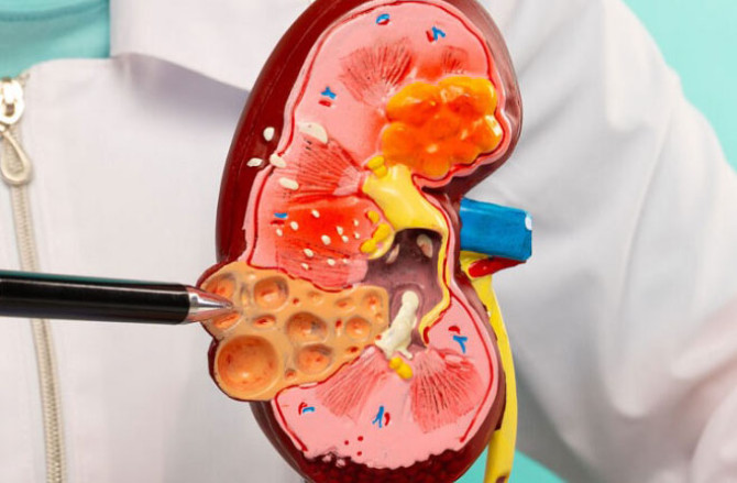 ’’سی کے ڈی‘‘  کیا ہے جو اتنا پھیل رہا ہے؟