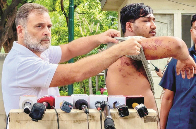Rahul Gandhi showing the media the marks of pellet gun injuries on Sahil. (PTI)